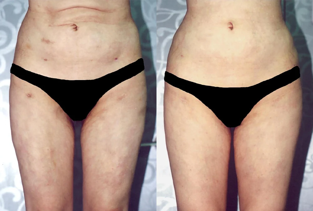 Body 성형 흉터 시술 전후 사진 10 · 보니따의원