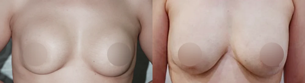 가슴 재수술, 보형물을 바꿀까요 아니면 빼고 채울까요? · 전후 사진 1