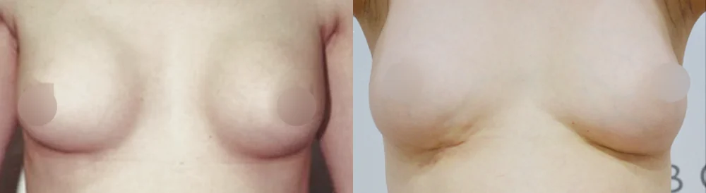가슴 재수술 시술 전후 사진 13 · 보니따의원