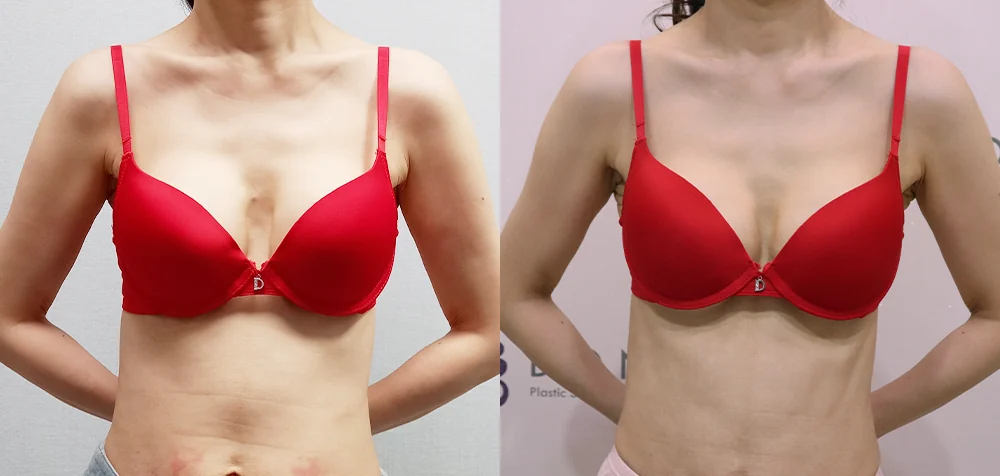 가슴 재수술 시술 전후 사진 1 · 보니따의원
