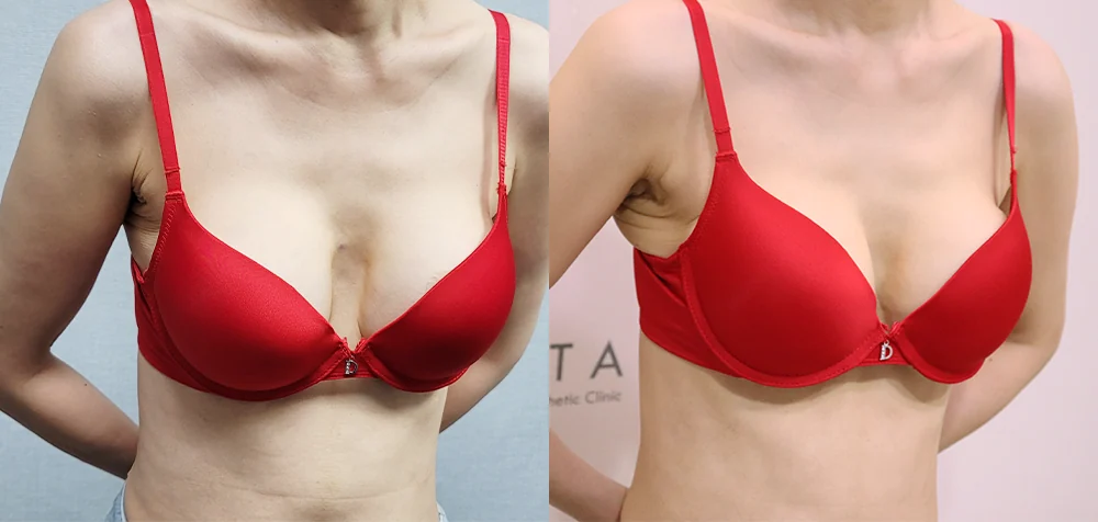 가슴 재수술 시술 전후 사진 2 · 보니따의원