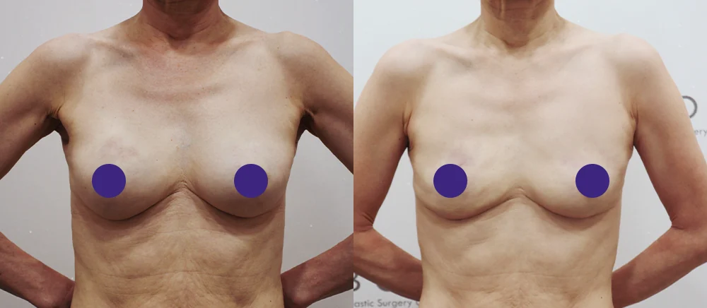 가슴에 주사한 필러·이물질, 빼야 할까요? 빼고 나면 어떻게 채우나요? · 전후 사진 1