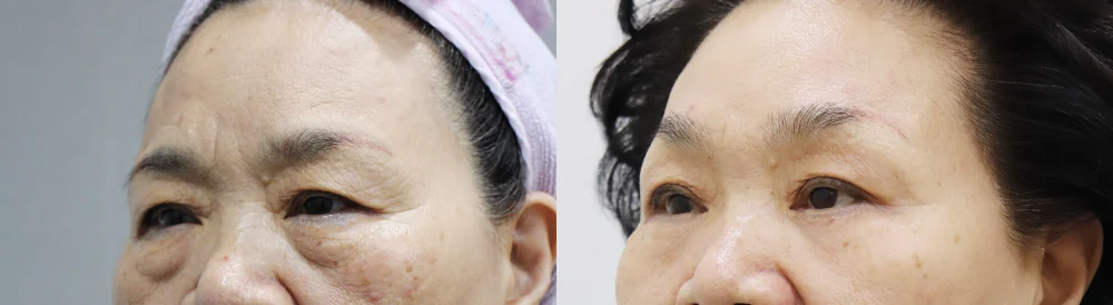눈썹위거상 시술 전후 사진 2 · 보니따의원