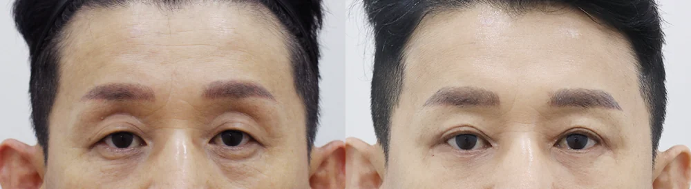 눈꺼풀이 무거운 이유가 눈썹 처짐일까요? 눈썹위거상이 맞는 경우 · 전후 사진 1