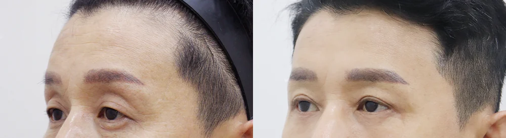 눈썹위거상 시술 전후 사진 8 · 보니따의원