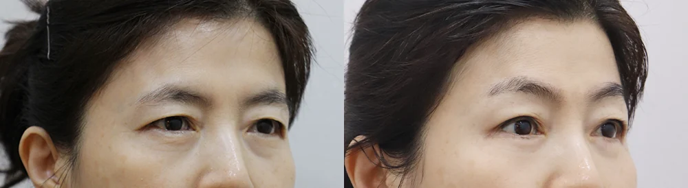 눈썹위거상 시술 전후 사진 25 · 보니따의원