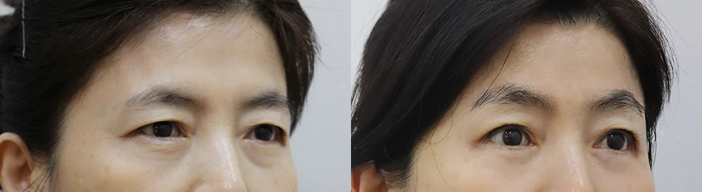 눈썹위거상 시술 전후 사진 26 · 보니따의원