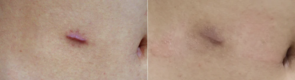 켈로이드와 비후성 흉터, 무엇이 다르고 어떻게 구별하나요? · 전후 사진 3