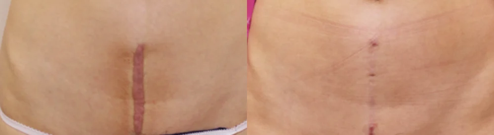 켈로이드와 비후성 흉터, 무엇이 다르고 어떻게 구별하나요? · 전후 사진 1