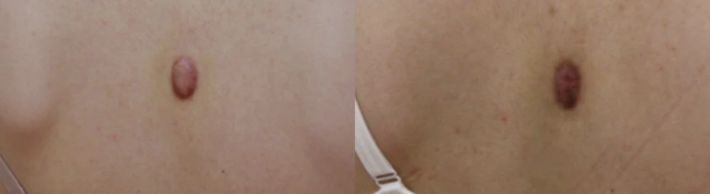 화상 및 켈로이드 치료 시술 전후 사진 13 · 보니따의원