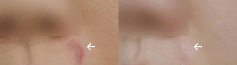 화상 및 켈로이드 치료 시술 전후 사진 14 · 보니따의원