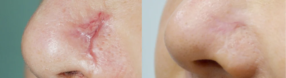 화상 및 켈로이드 치료 시술 전후 사진 15 · 보니따의원