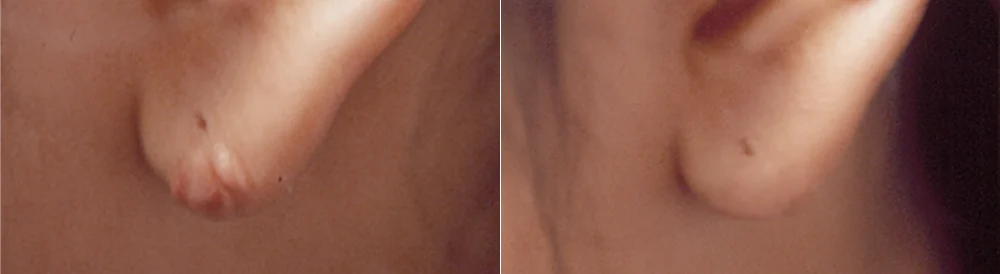 화상 및 켈로이드 치료 시술 전후 사진 16 · 보니따의원