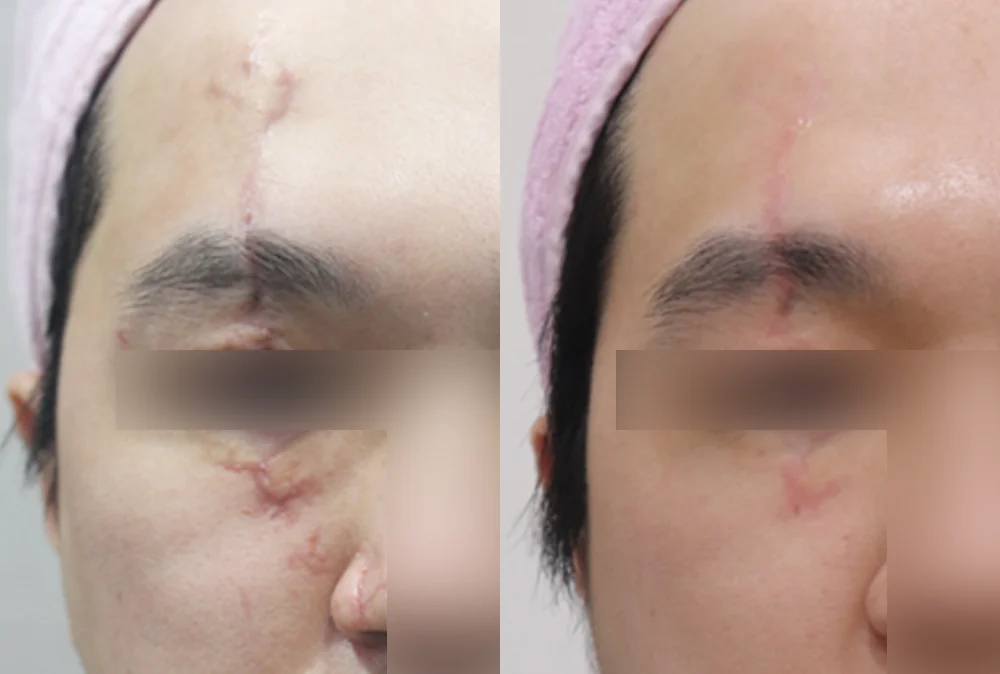 화상 및 켈로이드 치료 시술 전후 사진 4 · 보니따의원