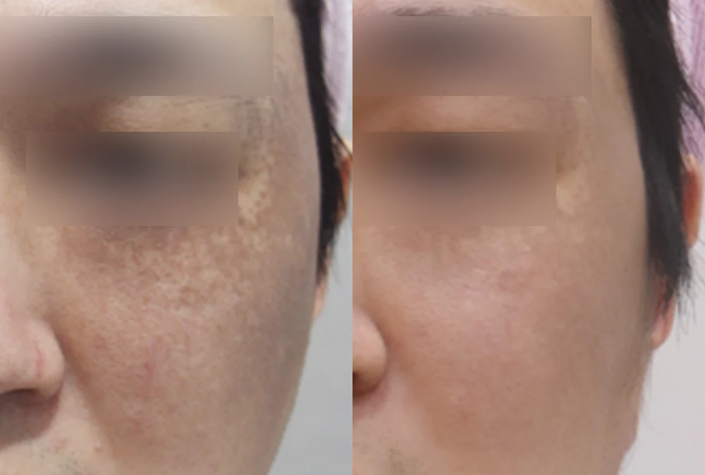 화상 및 켈로이드 치료 시술 전후 사진 2 · 보니따의원