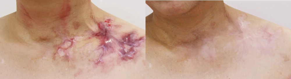 이미 자리 잡은 화상 흉터, 어디까지 복원할 수 있을까요? · 전후 사진 1