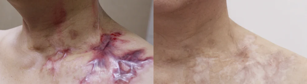 이미 자리 잡은 화상 흉터, 어디까지 복원할 수 있을까요? · 전후 사진 2