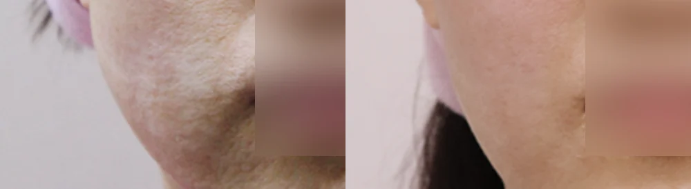 화상 및 켈로이드 치료 시술 전후 사진 20 · 보니따의원
