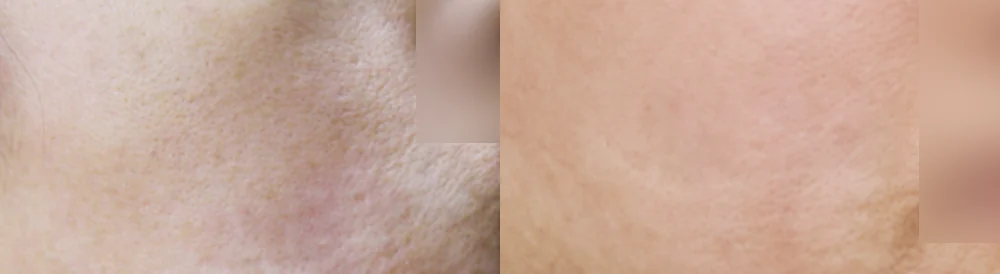 화상 및 켈로이드 치료 시술 전후 사진 21 · 보니따의원