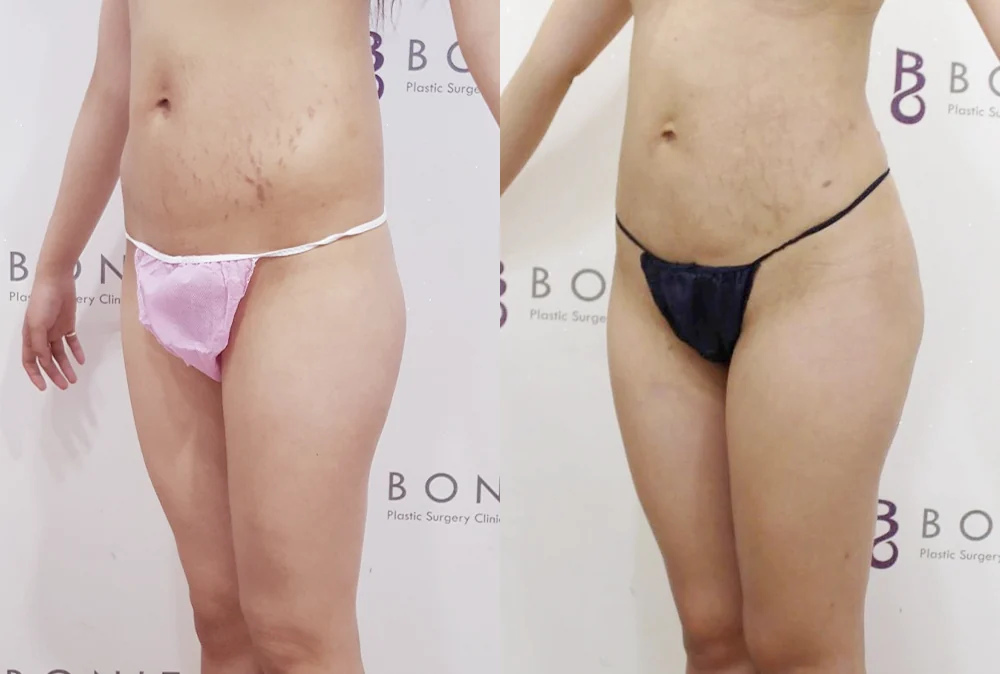 체형성형센터 시술 전후 사진 5 · 보니따의원