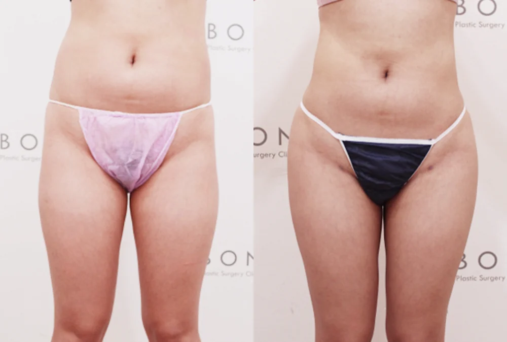 엉덩이 지방이식 시술 전후 사진 11 · 보니따의원