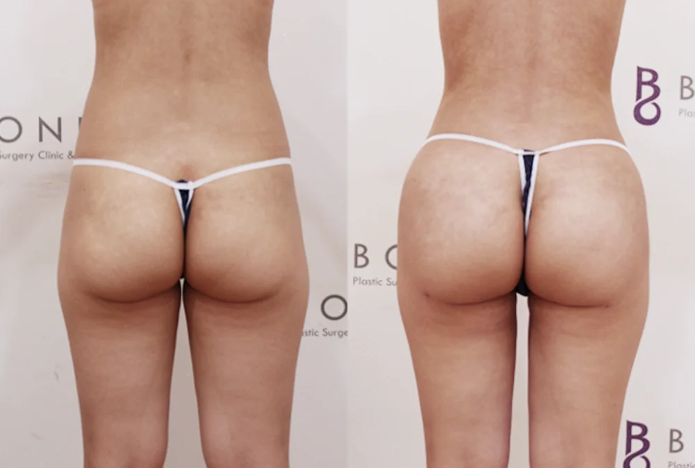 브라질리언 레이어드 힙업성형 시술 전후 사진 1 · 보니따의원