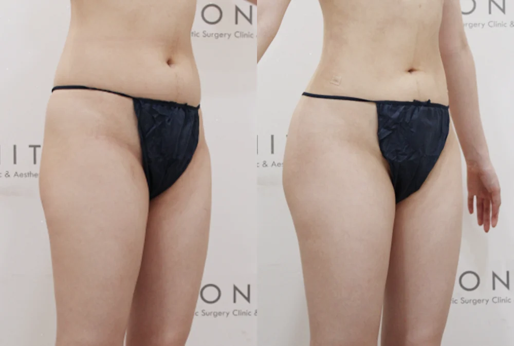 브라질리언 레이어드 힙업성형 시술 전후 사진 16 · 보니따의원