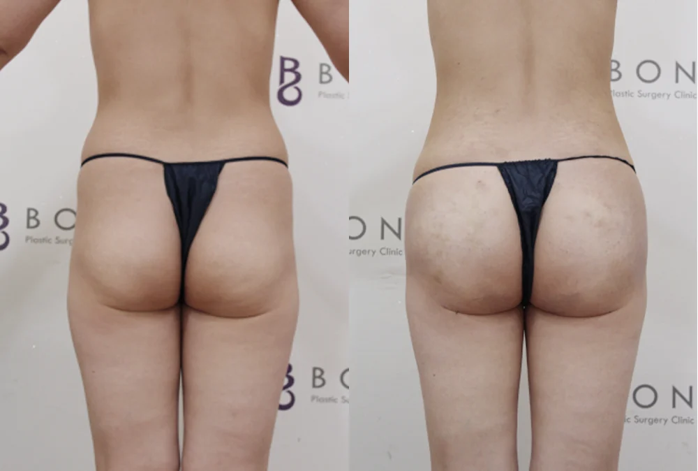 브라질리언 레이어드 힙업성형 시술 전후 사진 17 · 보니따의원