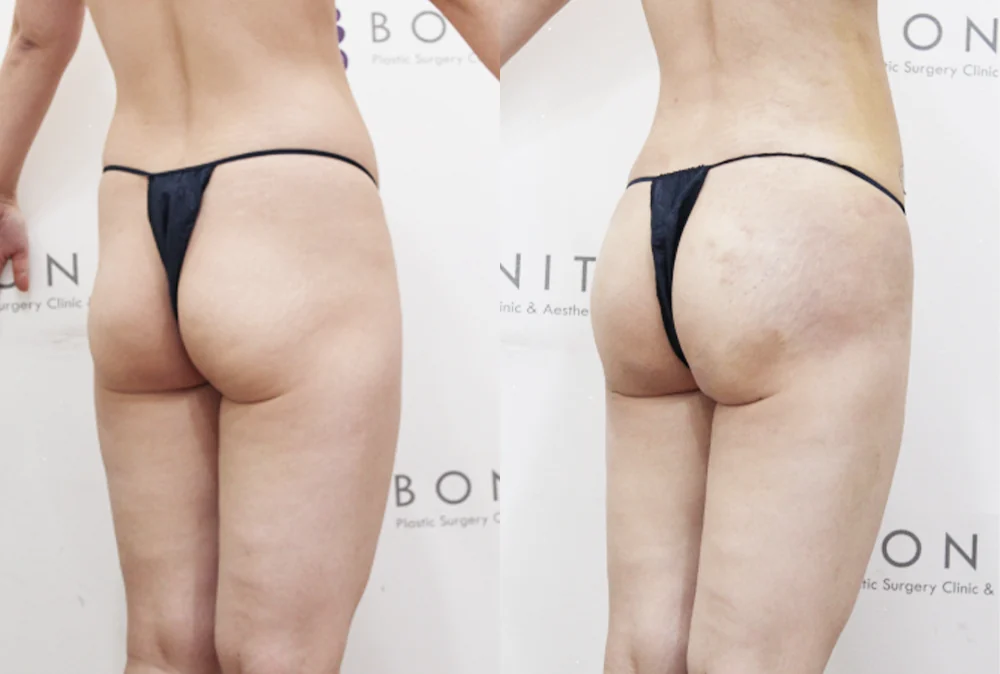 브라질리언 레이어드 힙업성형 시술 전후 사진 18 · 보니따의원