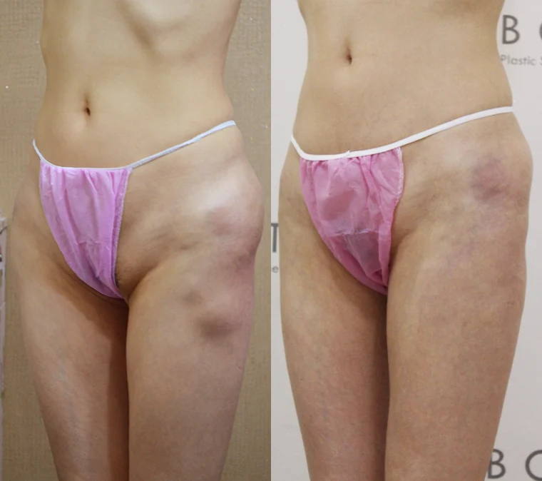 엉덩이·다리에 맞은 필러와 이물질, 굳고 염증이 나면 빼낼 수 있을까요? · 전후 사진 2