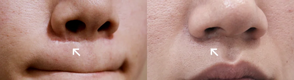 수두·마마 자국과 구순열 흉터, 오래됐어도 치료할 수 있을까요? · 전후 사진 4
