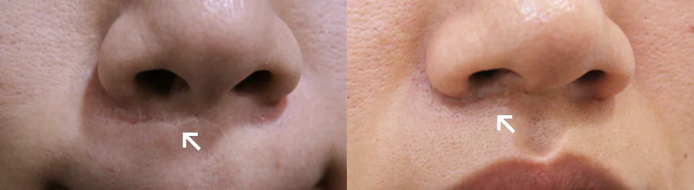 수두·마마·구순열 흉터 시술 전후 사진 3 · 보니따의원