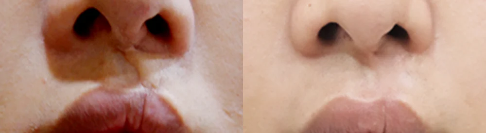 수두·마마 자국과 구순열 흉터, 오래됐어도 치료할 수 있을까요? · 전후 사진 2