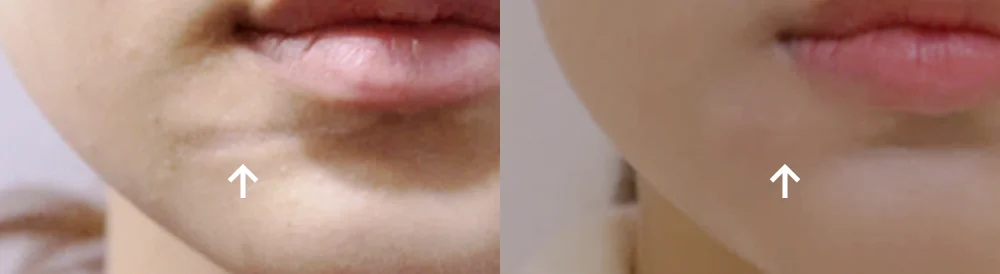 수두·마마·구순열 흉터 시술 전후 사진 9 · 보니따의원