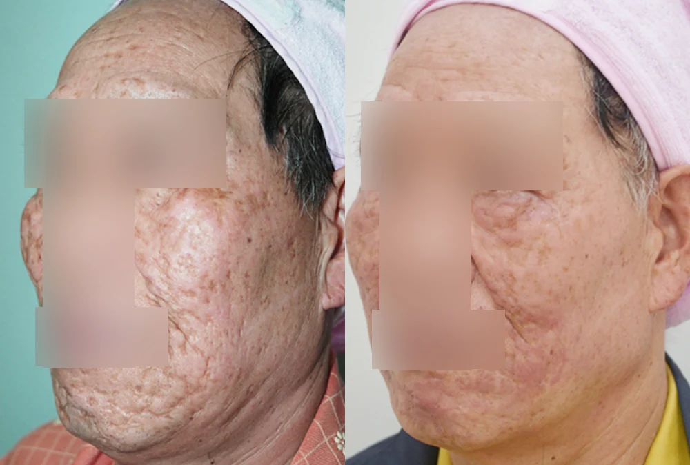 수두·마마 자국과 구순열 흉터, 오래됐어도 치료할 수 있을까요? · 전후 사진 1
