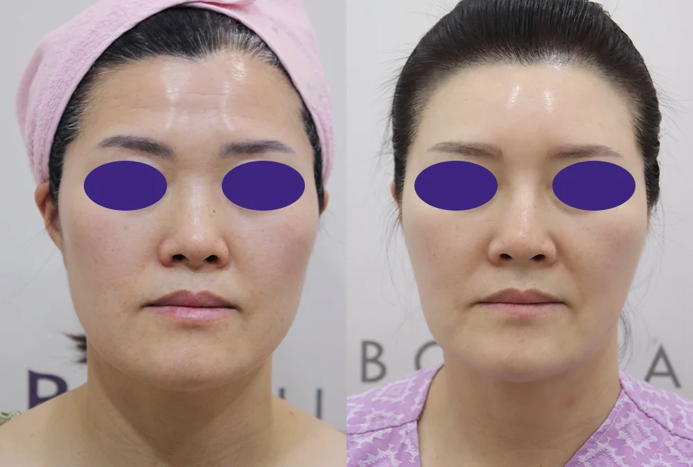 코 성형 시술 전후 사진 2 · 보니따의원