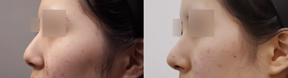 코 성형 시술 전후 사진 24 · 보니따의원