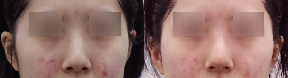 매부리코 성형 시술 전후 사진 5 · 보니따의원