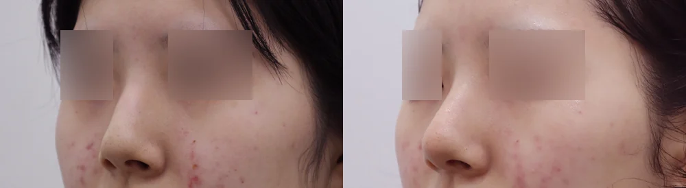 매부리코 성형 시술 전후 사진 6 · 보니따의원