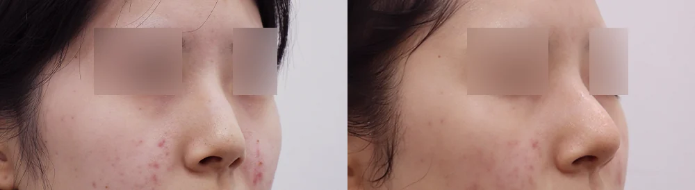 매부리코 성형 시술 전후 사진 8 · 보니따의원