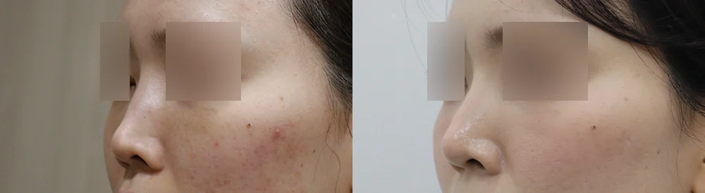 매부리코 성형 시술 전후 사진 10 · 보니따의원