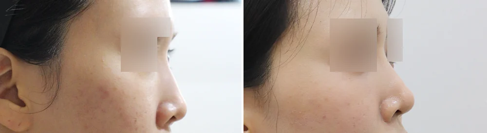 매부리코, 튀어나온 부분만 깎으면 될까요? · 전후 사진 2