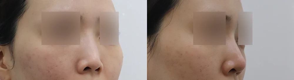 매부리코 성형 시술 전후 사진 12 · 보니따의원
