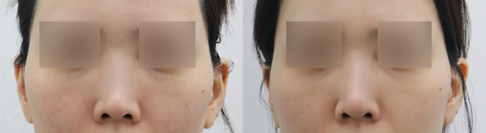 매부리코 성형 시술 전후 사진 13 · 보니따의원