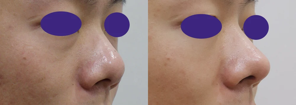 화살코 성형 시술 전후 사진 9 · 보니따의원