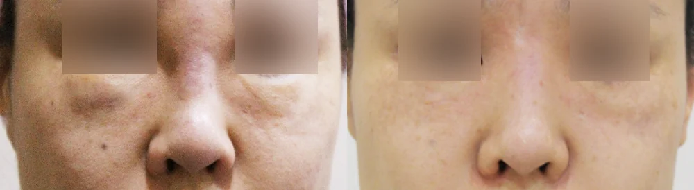 Under-Eye, Glabella and Nose Filler Removal in Seoul: How Far Can Removal Safely Go? · Before and after 1