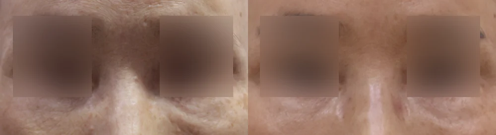 눈·미간·코 성형 부작용 재건 시술 전후 사진 18 · 보니따의원