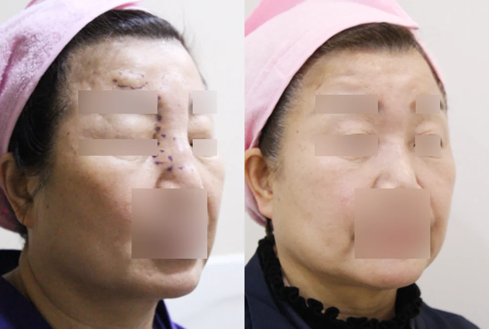 눈·미간·코 성형 부작용 재건 시술 전후 사진 2 · 보니따의원