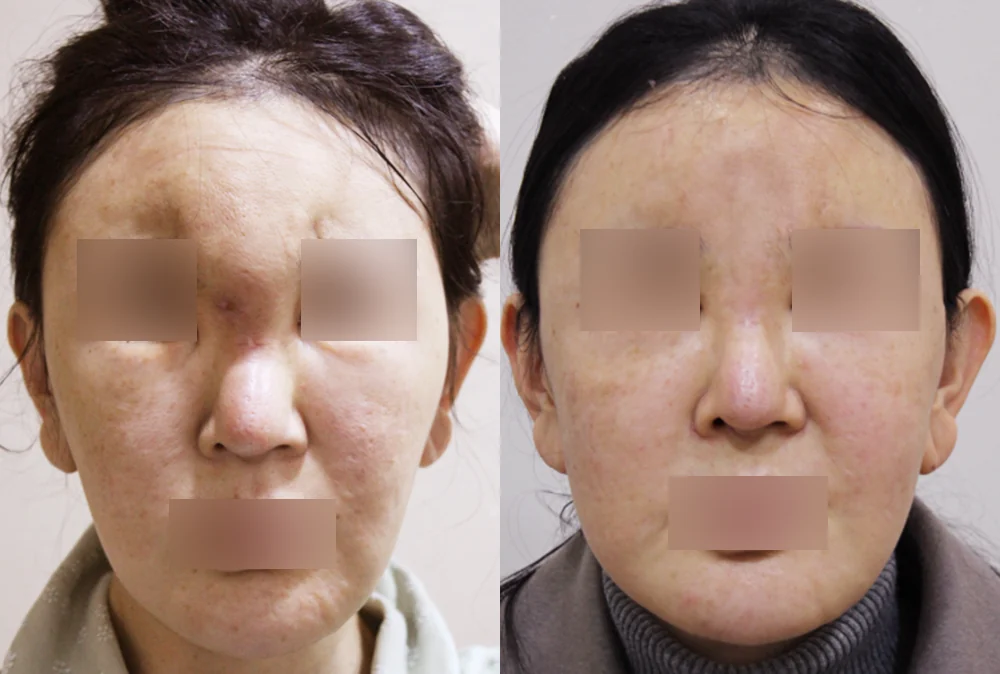 Under-Eye, Glabella and Nose Filler Removal in Seoul: How Far Can Removal Safely Go? · Before and after 3