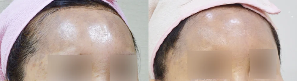 눈·미간·코 성형 부작용 재건 시술 전후 사진 19 · 보니따의원